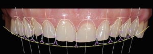 Digital Smile Design at Keystone Dentistry